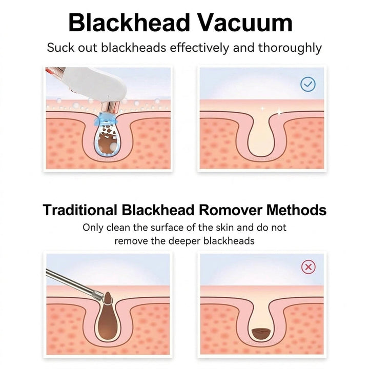 Deluxe Blackhead Remover Pore Vacuum Cleaner - 6-Probe Suction Facial Cleaner