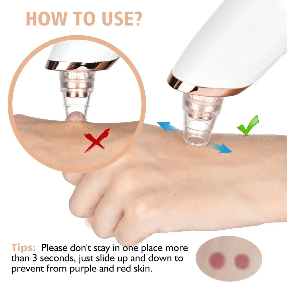 Blackhead Remover Pore Vacuum Cleaner - 5-Probe Suction Facial Cleaner
