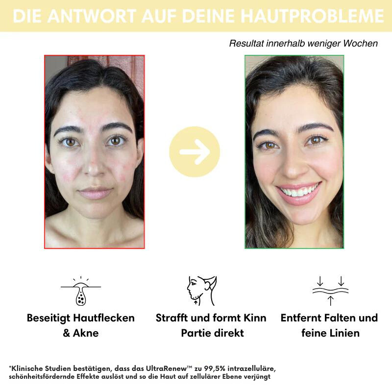 BowLift | UltraRenew - Youthful Appearance in Just 10 Minutes