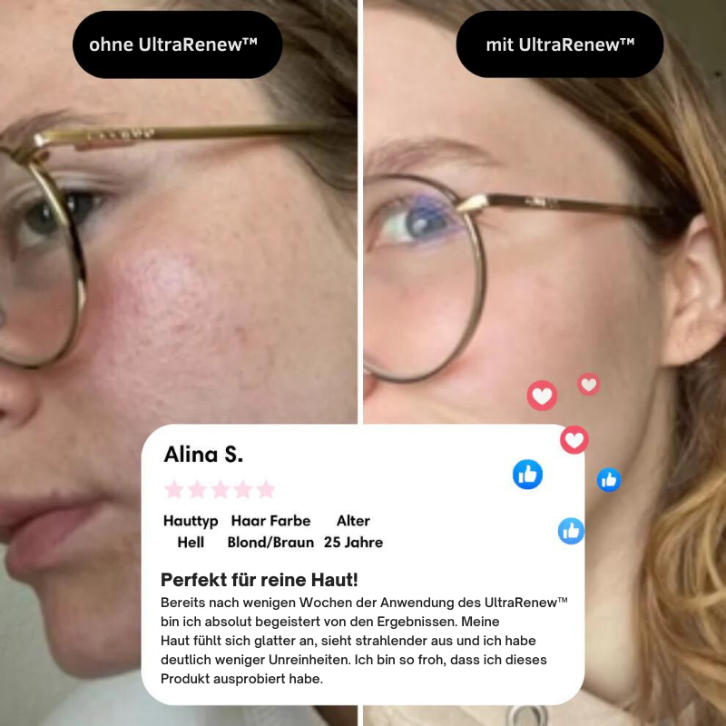 BowLift | UltraRenew - Youthful Appearance in Just 10 Minutes