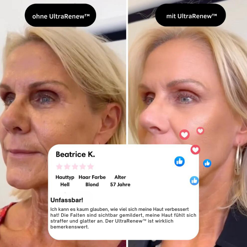 BowLift | UltraRenew - Youthful Appearance in Just 10 Minutes